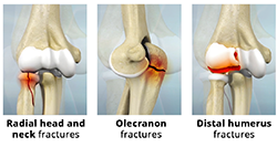 What are the Types of Elbow Fractures