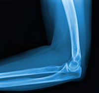 Diagnosis of Elbow Fractures