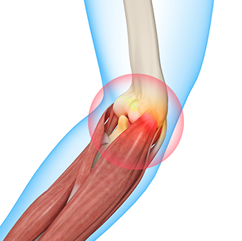 What is an Elbow Sprain