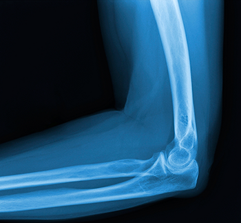 Diagnosis of Elbow Sprains