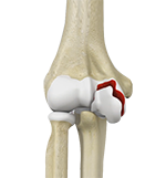 Elbow Fractures