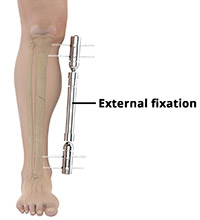 External fixation