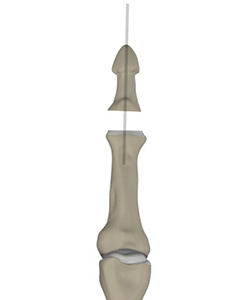 Finger Joint Fusion Procedure