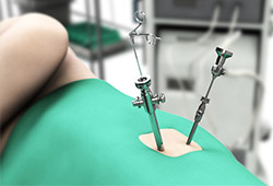 Hip Arthroscopy Procedure