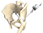 Hip Arthroscopy