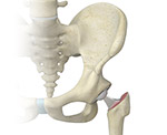 Hip Replacement