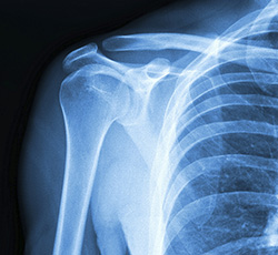 How is a Rotator Cuff Tear Diagnosed?