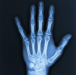 How is Arthritis of the Hand and Wrist Diagnosed?