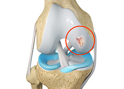 Indications for Chondroplasty