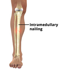 Internal fixation