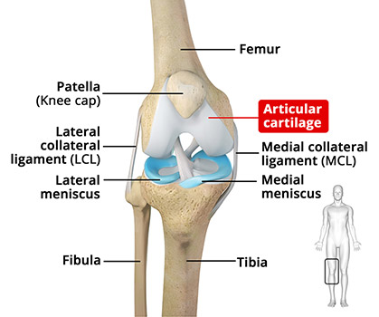 Knee Arthritis