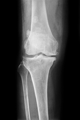 Knee Arthritis