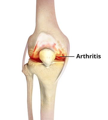 Knee Arthritis