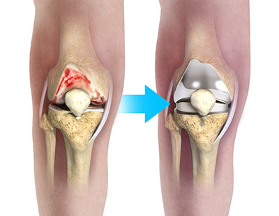 Knee Arthritis