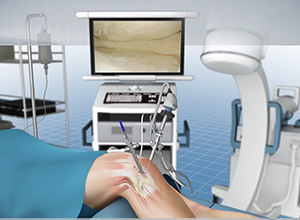 Knee Arthroscopy Procedure