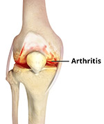 knee Causes