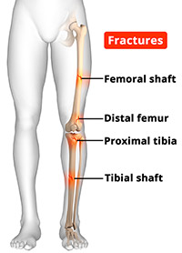 Knee Fracture