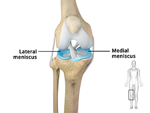 Meniscectomy