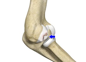 What is Osteochondritis Dissecans