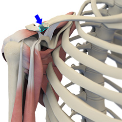 Procedure for Distal Clavicle Excision