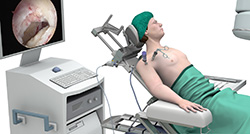 Procedure for Subacromial Decompression