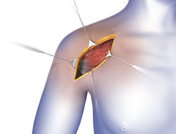 Revision Shoulder Replacement Procedure