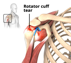 Rotator Cuff Arthropathy