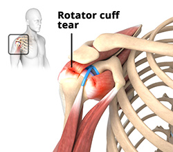 Rotator Cuff Tears