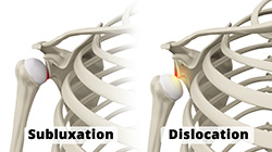 Causes of Shoulder Instability