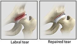 Surgery for Hip Labral Tears