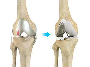 Surgical Procedure of Unicompartmental Knee Replacement