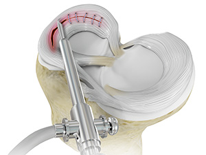 Surgical Treatment of Meniscal Tears