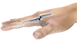 Surgical Treatment for Thumb and Digit Arthritis