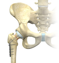 Surgical Treatment of Hip Fractures