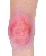 Symptoms of Kneecap Bursitis