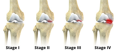 Symptoms of Osteonecrosis of the Knee