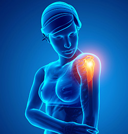 Symptoms of Shoulder Impingement