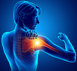 Symptoms of Shoulder Impingement