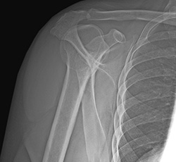 Symptoms of Shoulder Dislocation