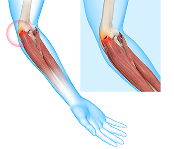 What is Tennis Elbow
