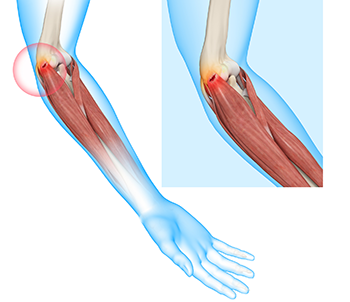 What is Tennis Elbow