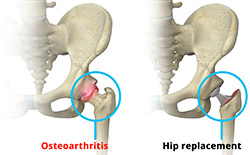 Total Hip Replacement Procedure
