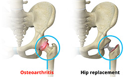 https://www.drmatanky.com/images/total-hip-replacement-procedure.jpg