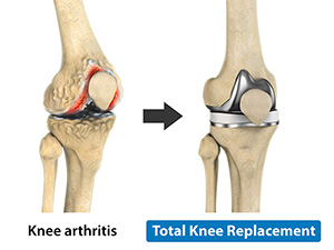 Total Knee Replacement