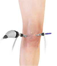 Treatment of Osteonecrosis of the Knee