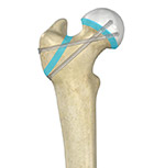 Treatments for Slipped Capital Femoral Epiphysis 