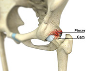 Femoroacetabular Impingement