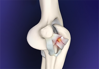 What is UCL Reconstruction