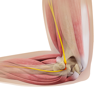 Ulnar Nerve Compression in Guyon's Canal  Advanced Orthopaedics & Sports  Medicine, Orthopaedic Specialists, Cypress, Houston, TX