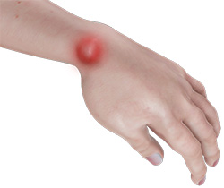 What are Ganglion Cysts